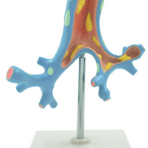 Pathological Model of the Bronchi, 1 Part