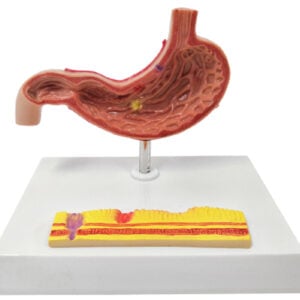 Gastric Pathology Model, 2 Part