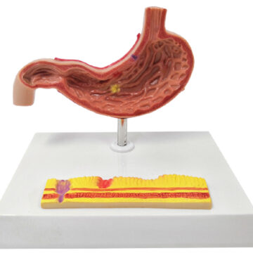 Gastric Pathology Model, 2 Part