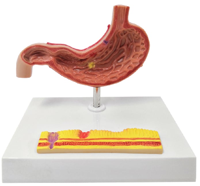 DS-50908 - Gastric Pathology Model, 2 Part Gastric Pathology Model, 2 Part