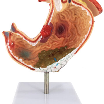 Gastric Pathology Model with Diaphragm, Life Size