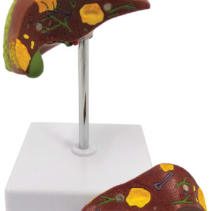 Pathological Model of the Liver, 2 Part