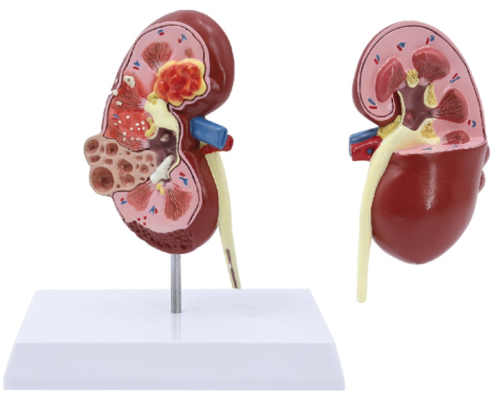 DS-50913 - Two-sided Normal & Pathologies Kidney Model Two-sided Normal & Pathologies Kidney Model