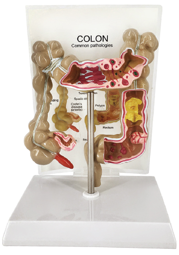 DS-50914 - Pathological Model of Colon and Rectum, Half Size Pathological Model of Colon and Rectum, Half Size