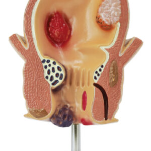 Pathological Model of the Rectum, 1 Part
