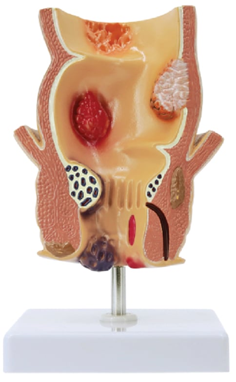 DS-50915 - Pathological Model of the Rectum, 1 Part Pathological Model of the Rectum, 1 Part