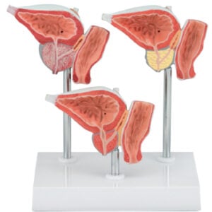 Normal and Diseased Prostate Gland, 3Parts
