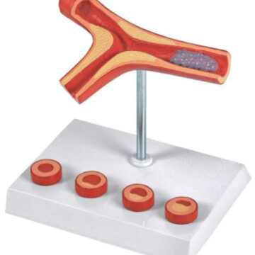 Atheriosclerosis and Thrombosis Model(10x Enlarged), 5 Parts