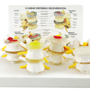 4-Stage Degenerative Lumbar Spine Model, 4 Parts