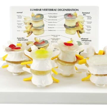 4-Stage Degenerative Lumbar Spine Model, 4 Parts