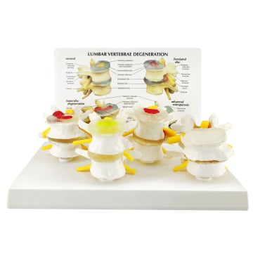 4-Stage Degenerative Lumbar Spine Model, 4 Parts