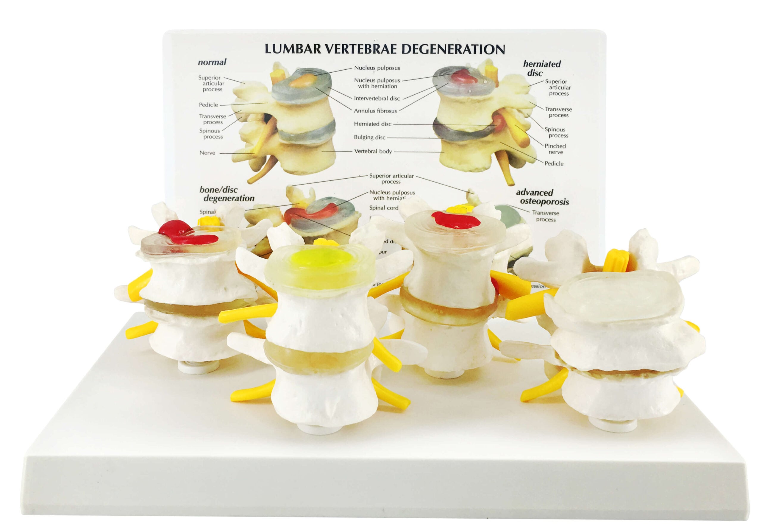 DS-50923 - 4-Stage Degenerative Lumbar Spine Model, 4 Parts 4-Stage Degenerative Lumbar Spine Model, 4 Parts