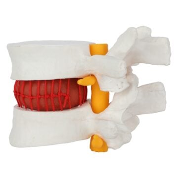 Herniated Intervertebral Disc Model